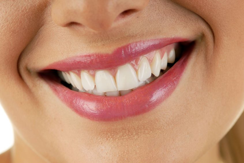 Things to Know if You Need Dental Veneers