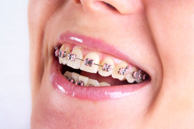 How an Orthodontist Can Help You Choose Adult Braces