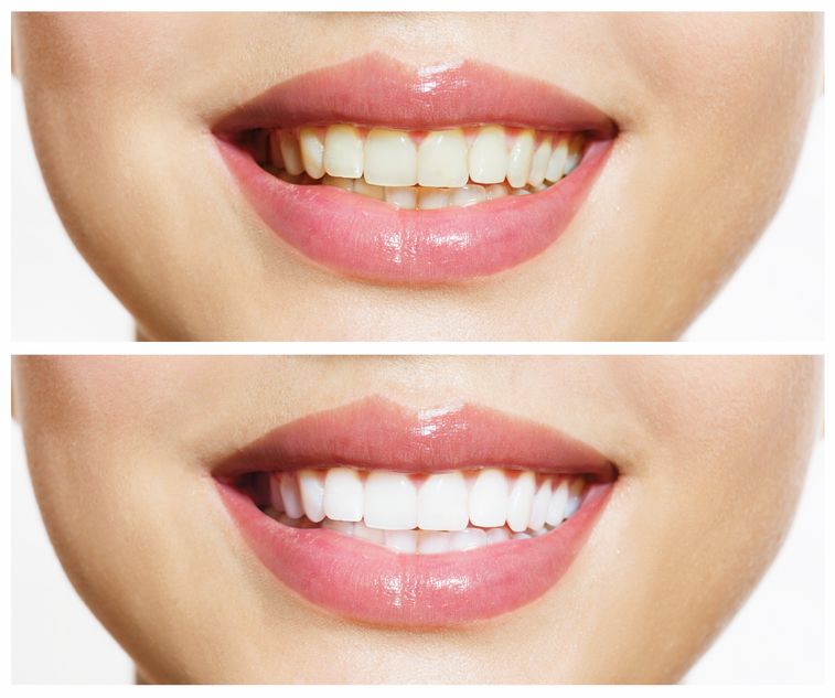 Utilizing a Cosmetic Dentist Providing Dental Veneers in Glenview